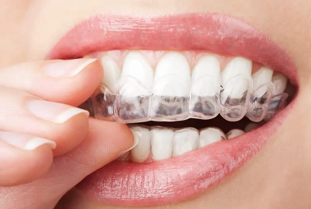 Can Invisalign Fix My Underbite?