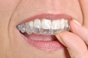 The Average Cost Of Invisalign - Mill Creek Orthodontics