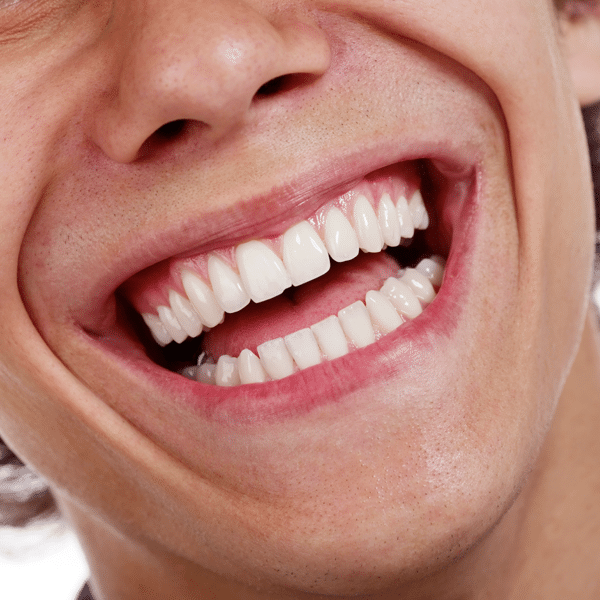 Invisalign Vs. Smile Direct Club - Mill Creek Orthodontics