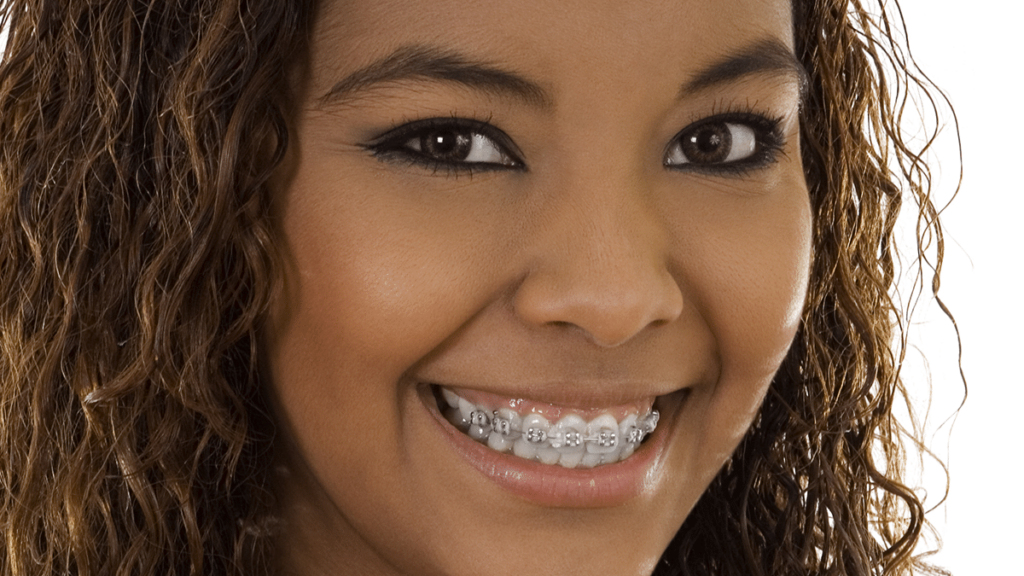 How much do braces cost monthly