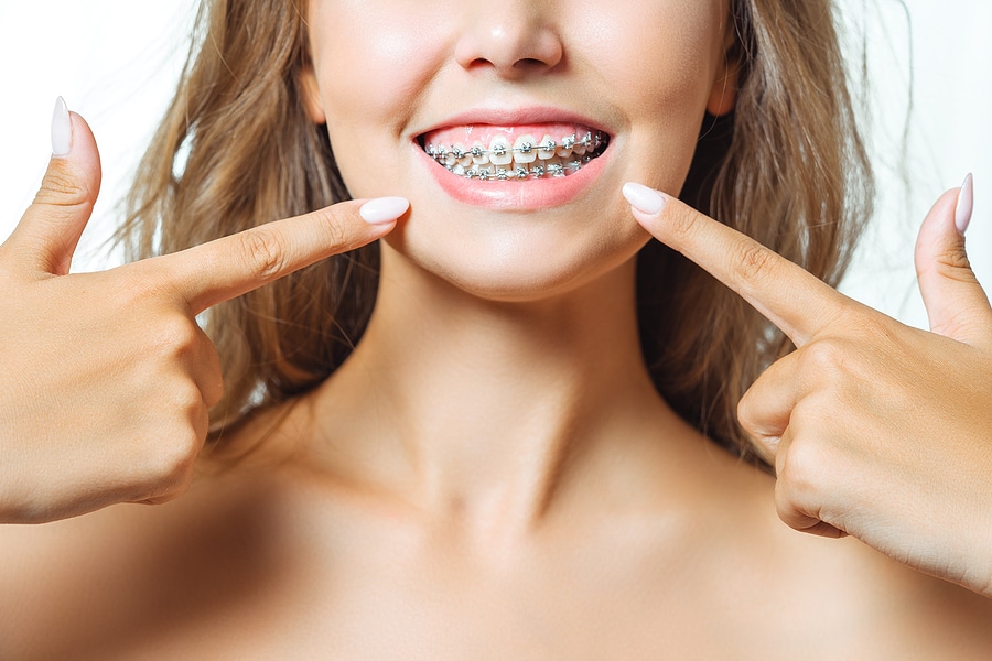 A young woman with traditional metal braces smiling and pointing at her braces